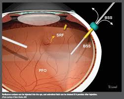 It can happen if a tear or hole develops in your retina. Surgeon Provides Pearls For Handling Retinal Tears