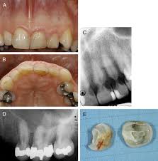 Reiter am, lyon kf, nachreiner rf, shofer fs. Human And Feline Invasive Cervical Resorptions The Missing Link Presentation Of Four Cases Journal Of Endodontics