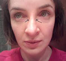 Eyeglass accessories, jewelry, and retainers that prevent nose dents, marks, and keeps glasses from slipping down your nose. Persistent Indentations On Nose Bridge After Having Sunglasses On For Just 5 Seconds 2 Weeks After Rhinoplasty Photos