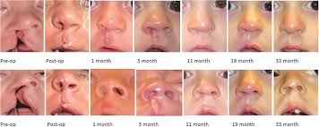 Longitudinal Anatomic Analysis of Primary Cleft Lip Rhinoplasty Outcomes