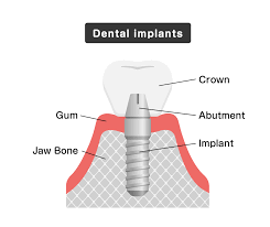 Image result for dental implant