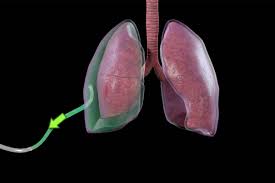 Image result for Pneumothorax
