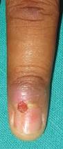 Image result for Pyogenic Granuloma