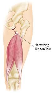 Groin is the area of the actual junction of the inner thigh and torso including the genitals.crotch is more of a slang word which simply refers to between the legs area.hopefully that. Hamstring Muscle Injuries Orthoinfo Aaos
