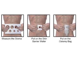 Global Ostomy Care Accessories Market 2021 Know About