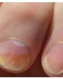 Image result for Pitting nails feet
