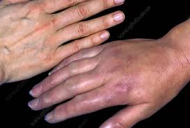 Image result for Systemic Sclerosis