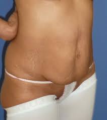Schlaffe Haut Nach Schwangerschaft So Wird Der Bauch Straff