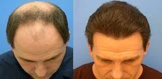 A 2019 study further encourages the use of dermarolling as it reduces hair loss, and participants could tell their hair was thicker and denser. Hair Loss Derma Roller