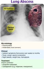 Image result for Lung Abscess