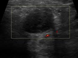 By preoperative neck us status are shown in table 1. Non Thyroid Cystic Masses Identified On Neck Ultrasound