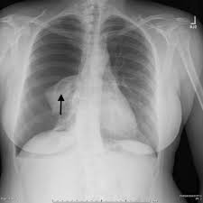 Check spelling or type a new query. Spontaneous Pneumothorax In A Young Woman The American Journal Of Medicine