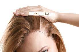 تساقط الشعر بعد التكميم الأسباب والحلول تجميلي