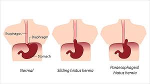 Hiatal Hernia Symptoms Causes Diagnosis And Treatment