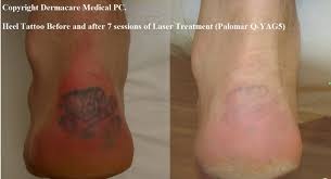 Laser tattoo removal laser tattoo removal in mobile, al can effectively diminish and possibly remove tattoos. All You Have To Know About Laser Tattoo Removal Fmag Com