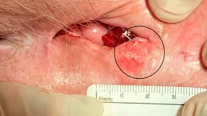 Image result for Vulvar Cancer