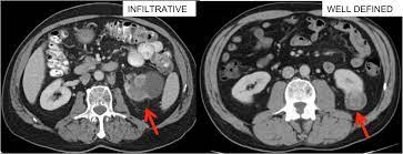But they can also cause cancer. Kidney Cancer Diagnosis Johns Hopkins Medicine