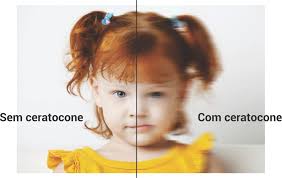 Resultado de imagem para ceratocone