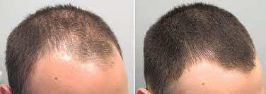 How does rogaine work for hair? Does Rogaine Work For Hairline Vertex Thinning Women Beards