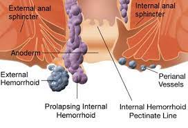 Jorge rodriguez explains what hemorrhoids are and how they are treated in the video below: How To Get Rid Of Hemorrhoids Types Causes And Treatments