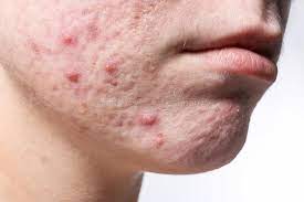 48 325 Acne Fotos Fotos De Stock Gratuitas E Fotos Royalty Free Dreamstime