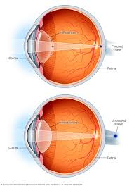 Presbyopia Symptoms And Causes Mayo Clinic