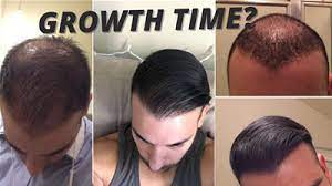 In terms of new hair growth, you would need to wait for at least three to four months to see visible results. How Long Does It Take For A Hair Transplant To Grow Hair Transplant Info