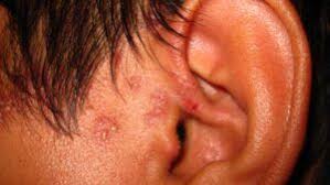 Image result for white scabs on the head in children