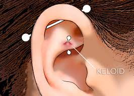 Understanding Keloids What How Why Bodycandy