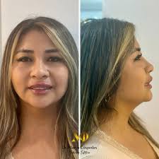 Reafirma, rejuvenece y luce radiante ✨ El Endolifting redefine tu rostro,  estimula colágeno y mejora la flacidez. 👨‍⚕ ¡Resultados naturales y sin  downtime! 🔥 ¿Lista para verte increíble? . . . #Endolifting  #RejuvenecimientoFacial