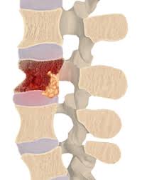 Image result for Spinal Infection