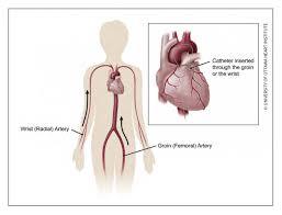Angiogram Cardiac Catheterization Ottawa Heart Institute