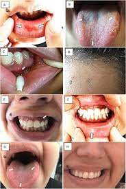 Covid tongue is an inflammatory disorder that usually appears on the top and sides of the tongue. Oral Manifestations In A Patient With A History Of Asymptomatic Covid 19 Case Report International Journal Of Infectious Diseases