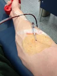 During a whole blood donation, blood is collected as one unit that contains 55% plasma, 45% red blood cells, and <1% platelets. Plasma Donate