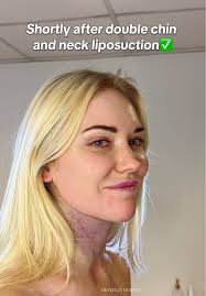 Immediately after double chin and neck liposuction✅😍 #lipopapada #chinlipo  #netherlands #holland #amsterdam