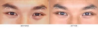 Specializes in breast augmentation, breast revision, liposuction, rhinoplasty and more. Asian Eyelid Double Eyelid Surgery Before And After Photo Gallery
