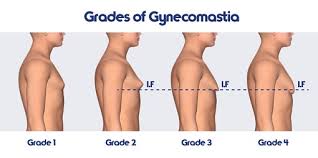 What Is Gynecomastia Male Boobs How Can You Treat Them Naturally
