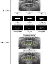 Deep Learning Hybrid Method to Automatically Diagnose Periodontal Bone Loss  and Stage Periodontitis | Scientific Reports