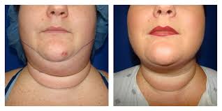 Traditional liposuction's average cost is placed at $3,500. Chin Liposuction Houston Lipo Center