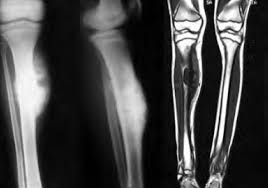 Image result for Ewing Sarcoma