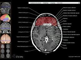 Cross Sectional Anatomy Of The Brain Brain Anatomy Mri Brain Mri