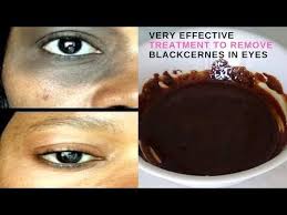 Traitement Tres Efficaces Pour Supprimer Les Cernes Noires Sous Les Yeux Youtube Cernes Noires Cernes Sous Les Yeux