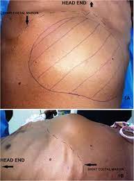 Pancreatic abscess within hepato-gastric ligament-Pancreatitis-Types-Causes-Symptoms-Diagnosis-Treatment-Homeopathic-Allopathic-Dr-Qaisar-Ahmed