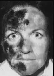 Some rare headache disorders, including Alice in Wonderland syndrome, blip  syndrome, cardiac cephalalgia, epicrania fugax, explo