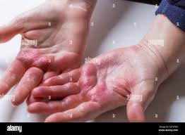 Dermatitis Atopica Roja Picazon En Las Manos Con Ampollas Y Piel Agrietada Fotografia De Stock Alamy
