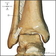 International statistical classification of diseases and related health problems. Medial Malleolus Fracture S82 53xa 824 0 Eorif