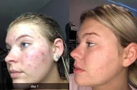 Dry skin face wash recommendations for acne prone skin