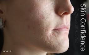 Thin profile tip the specialized plastic used in wrath tubes allows for a thin profile tip, while maintaining exceptional durability and heat resistance. Dry Tattooing Details Faqs Stretch Mark Treatment Scars Dry Tattooing Permanent Makeup Saline Tattoo Removal In Manchester