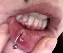 Infected Lip Piercing Causes Signs Treatment Cure Clean Pictures