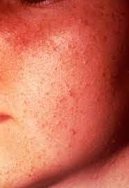 غير مناسب صراحة ذات مرة acne rosa kappa - ecorisemtl.org